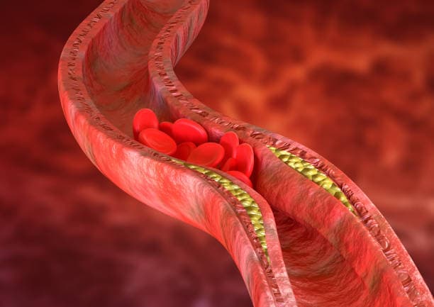 Blood Flow Atherosclerosis
